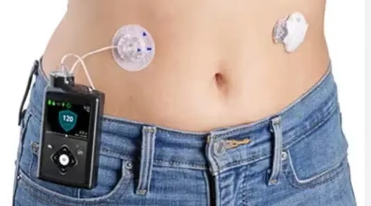 Insulin Pump Therapy